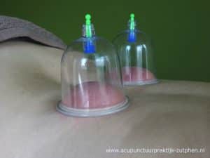 Cupping-Acupunctuur